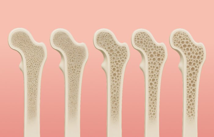 Bone density