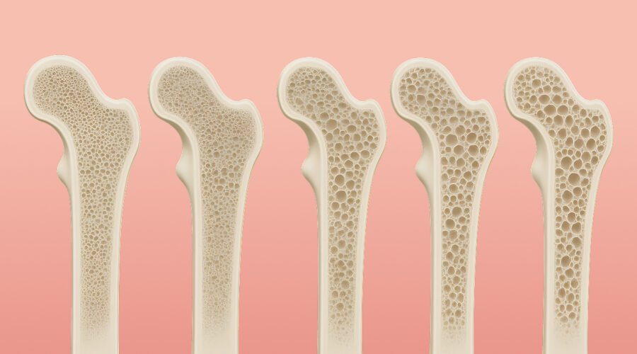 Bone density